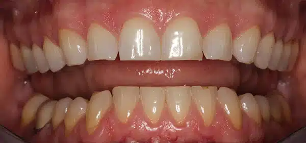M intraoral after