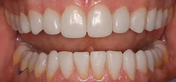 M intraoral before