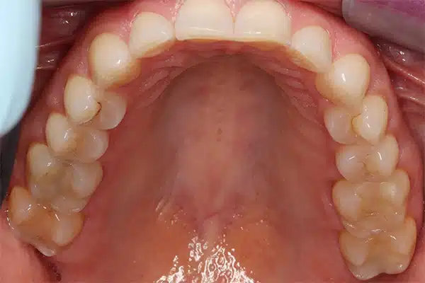 M mx occlusal before