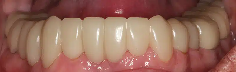 Denture After