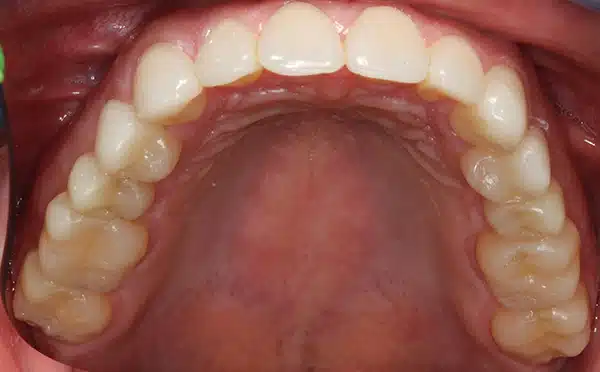 RP Mx Occlusal after