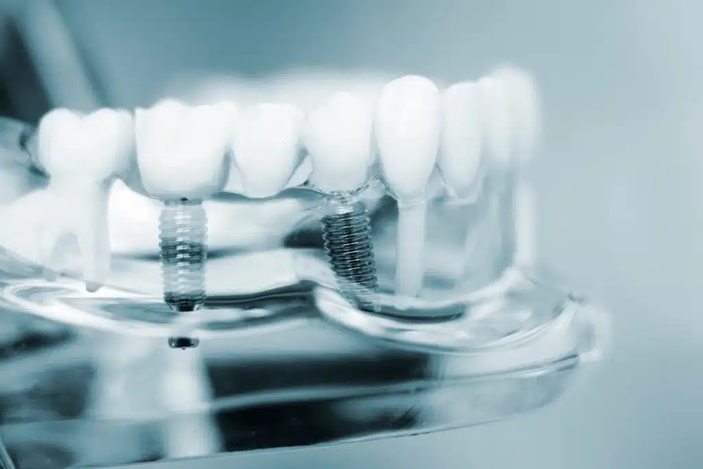 How Long Do Dental Implants Last?